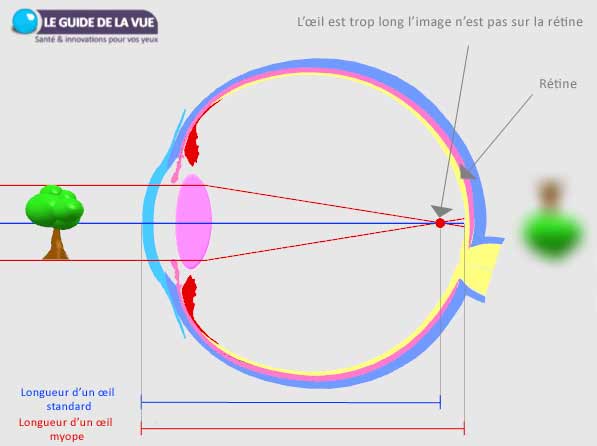 Schéma d'un œil myope